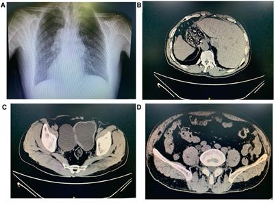 Laparoscopic bladder diverticulectomy in a child with situs inversus totalis: A case report and literature review